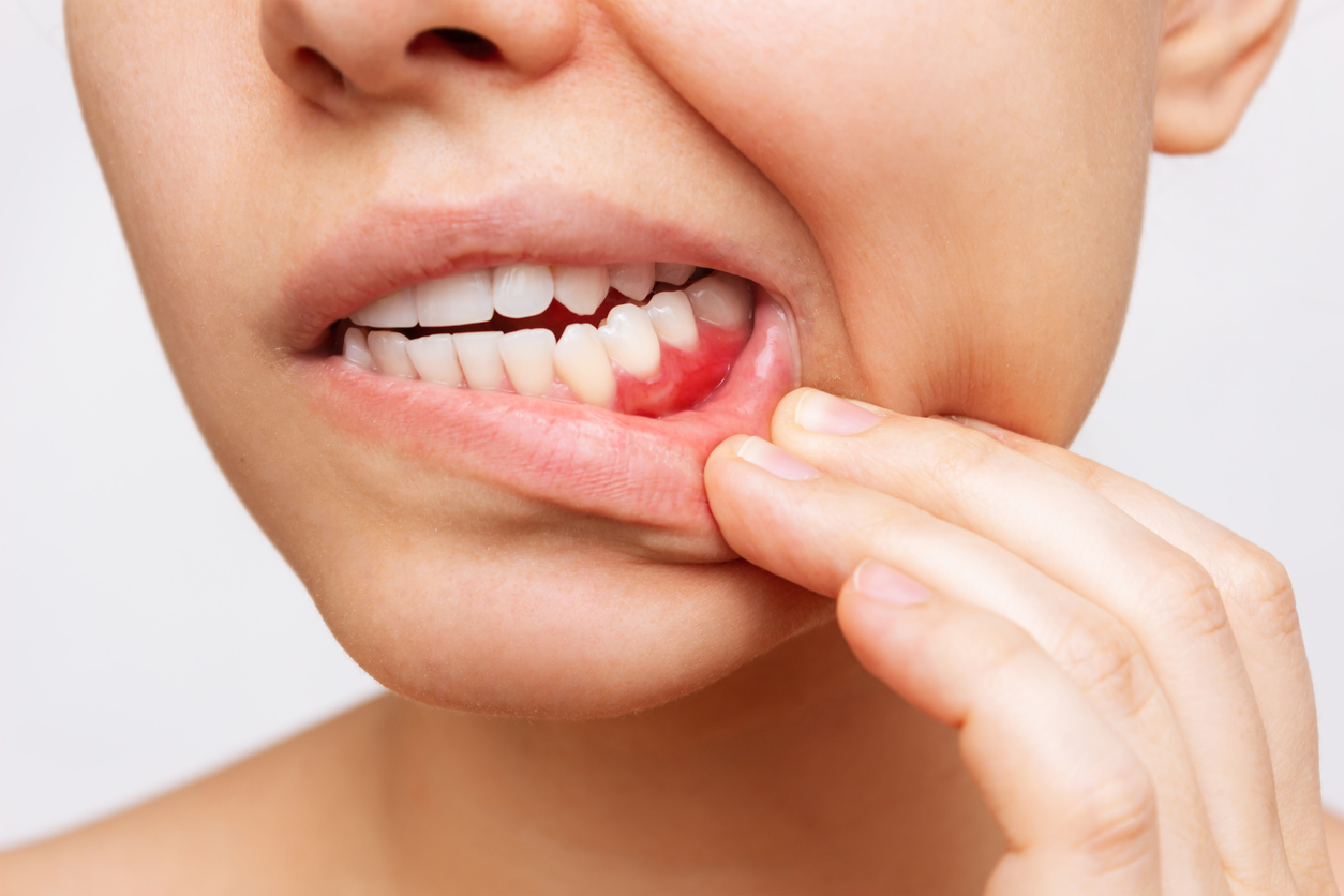 Recognizing Tooth Infection Signs When To Seek Treatment